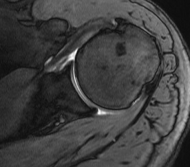 Subscapularis Tendinosis